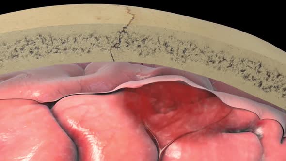 Cerebral hemorrhage as a result of an aneurysm bursting in the brain