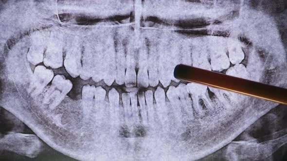 Dental X-Ray of Jaw with Teeth. Sealed Molars. Dentist Examines the Dental Arch