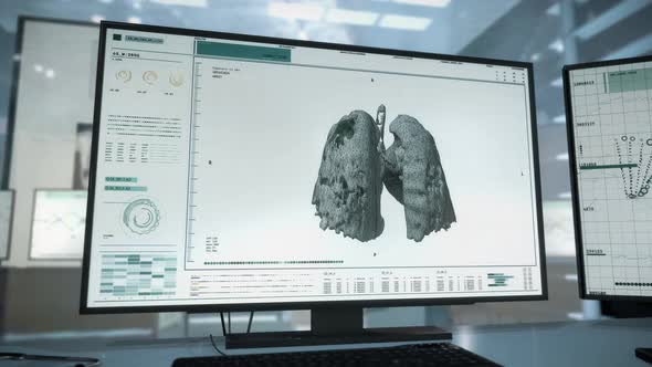 Medical Research Of Lungs In Modern Computer Software To Set Covid-19 Diagnosis alt