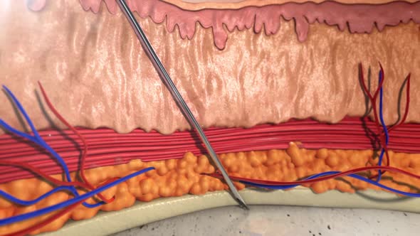 3d animation of hyaluronic acid injection with needle. Section of skin and epidermis layers