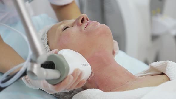 Resurfacing Facial Skin with a Laser