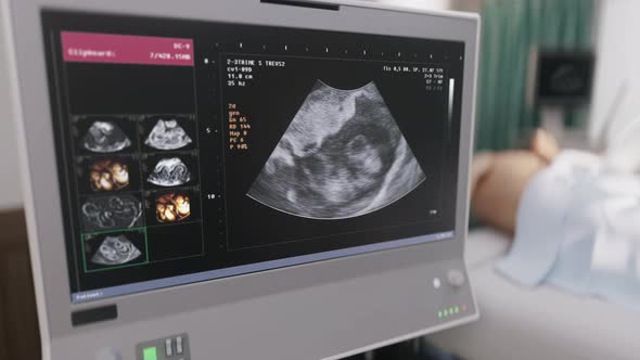 Hospital Pregnancy Scan Monitor Analyzing Health Of Twin Children In Belly