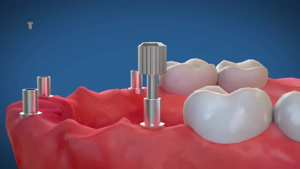 dentalprosthesis1.mov