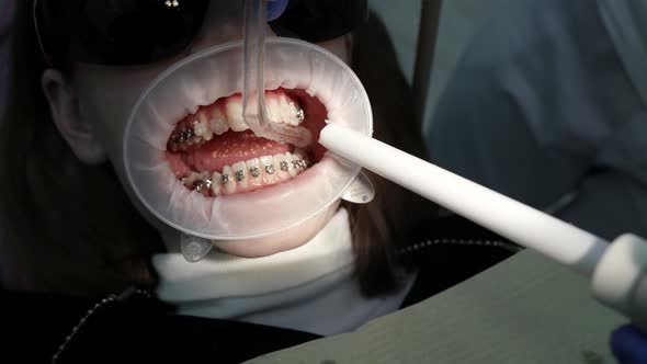 Closeup of a Patient with a Mouth Dilator in a Dental Chair Braces on His Teeth the Doctor Performs