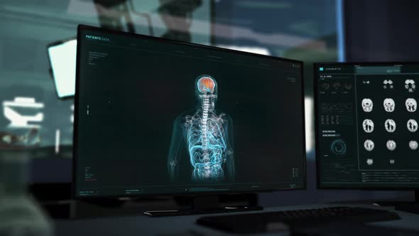 Futuristic interface of an x-ray finding Brain Tumor in the skull at a hospital alt