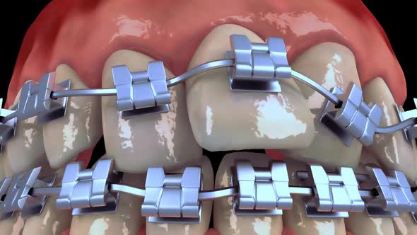 Aligning Teeth With Braces
