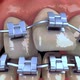 Aligning Teeth With Braces - VideoHive Item for Sale