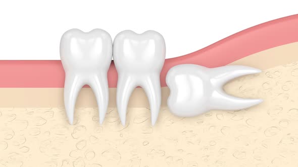 Teeth in gums with wisdom tooth horizontal impaction