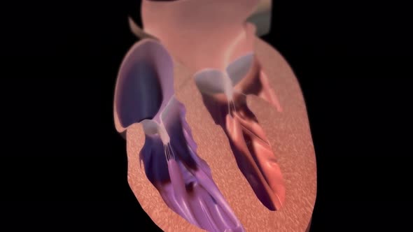 Animated Congestive Heart Failure 3d