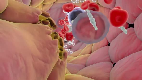 Plaque formation in the cardiovascular tract, cholesterol