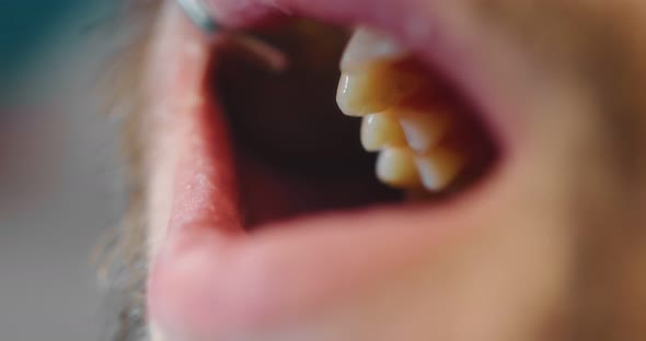 Dentist Examines the Patient's Oral Cavity Using a Dental Mirror