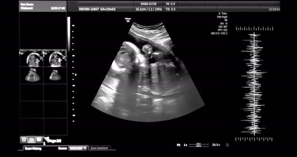 4K - Medical ultrasound scanning. baby silhouette