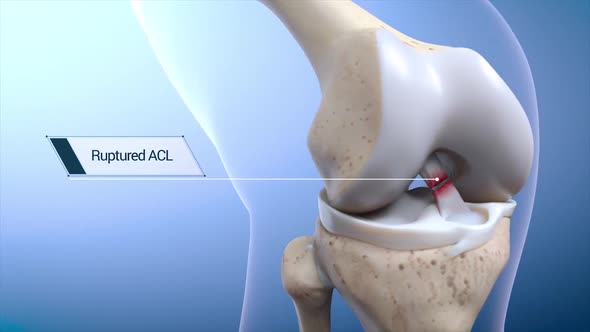 Anterior Cruciate Ligament (ACL) Injury or Tear