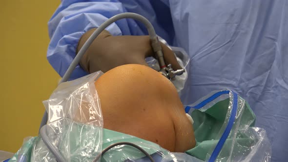 Knee Arthroscopy 3