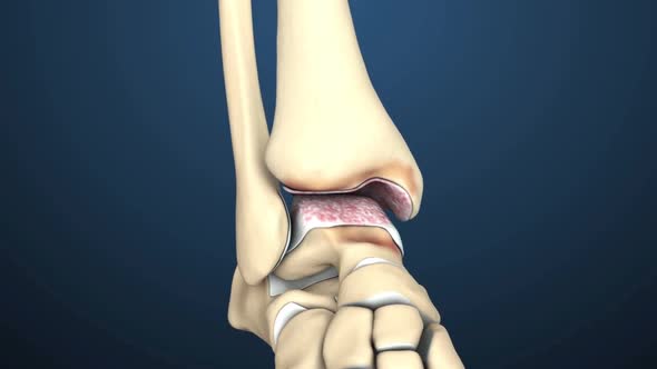 Osteoarthritis is the most common form of arthritis