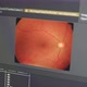 Diabetic and Hypertensive retinopathy Glaucoma Detection with Neural Network ML - VideoHive Item for Sale