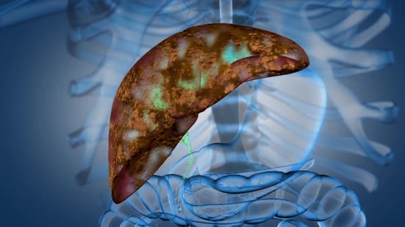 The Progression of Liver Disease. Liver failure