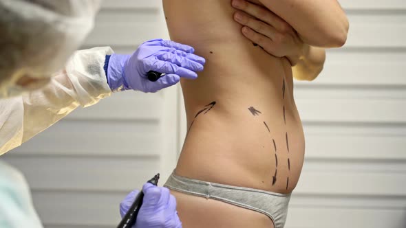 Plastic Surgeon Prepares Patient Liposuction Surgery