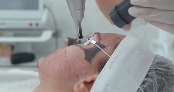 Carbon Face Peeling Procedure. Laser Pulses Clean Skin of the Face. Hardware Cosmetology Treatment