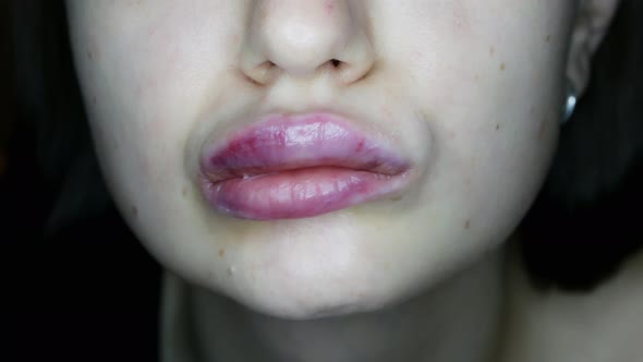 Close-up of Swollen Lips After Injections of Hyaluron, Lip Augmentation