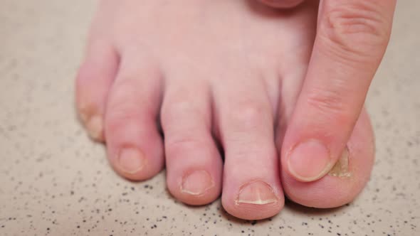 Toenails with Fungal Infection and Bruise on Big Toe Macro