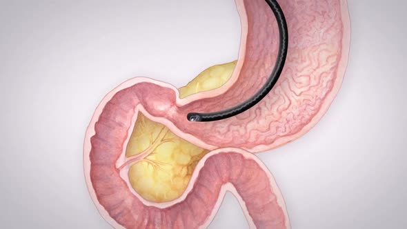 pancreatic endoscopy  medical animation