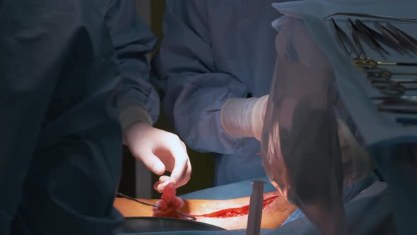 Team of Professional Doctors Operating a Patient Conducting Open Cut Surgery in Surgical Room