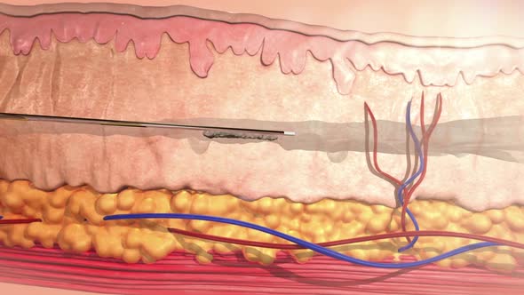 3d animation of hyaluronic acid injection. Section of skin exfoliation and epidermis with needle