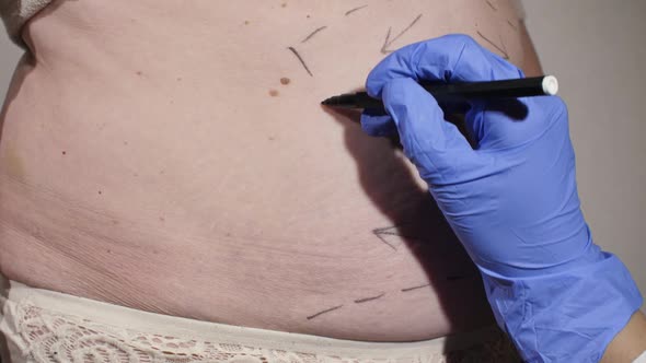 Surgeon Preparing Woman for Liposuction
