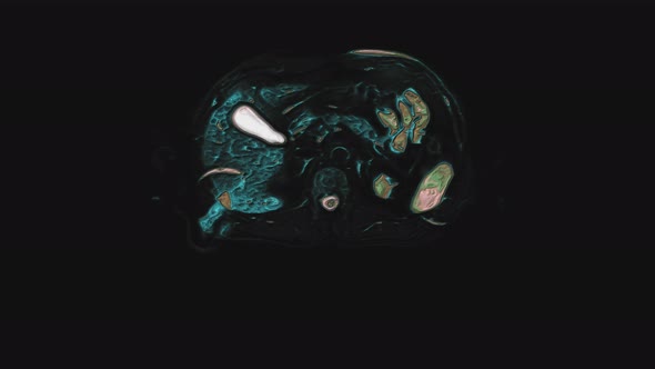 Bulk Multicolored CT Scan of the Abdomen