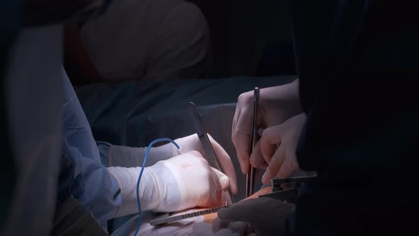 Closeup of Professional Doctor Hands Operating a Patient During Open Heart Surgery in Surgical Room