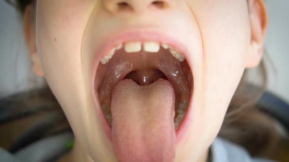 Wide Open Mouth with a Tongue Stuck Out View of the Uvula and the Soft Palate of Little Girl
