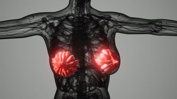 Medical Scan of Woman Breast Cancer alt
