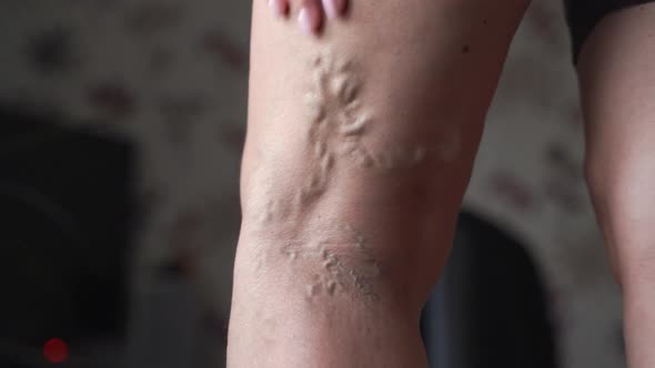 Varicose Veins on Woman Legs Indoors. Vascular Health Problem. Trombose on Female Legs