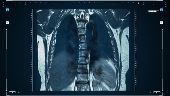 Xrays of the Human Lungs or Physical Therapy for Doctors with Lung Problems Such As Viruses Entering