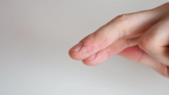 Fingers of a Man with Psoriasis and Eczema