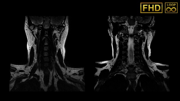 Mri Neck Spine