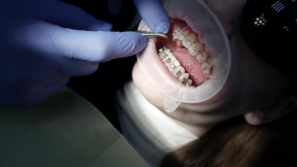 Closeup of a Doctor and a Patient with a Mouth Dilator in a Dental Office Braces on the Teeth