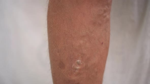 Varicose Veins and Age Spots on the Human Leg
