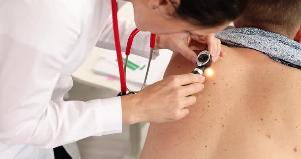 Doctor Oncologist Examining Patient Pigmented Nevus Using Dermatoscope  Movie