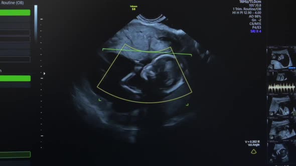 Ultrasound of Pregnant Woman