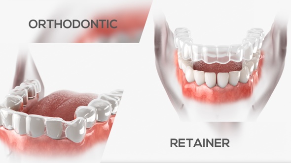 Orthodontic retainer