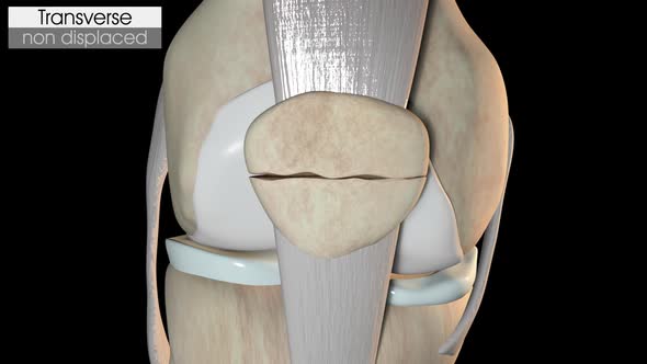 Patella Fracture   Transverse Non Displaced