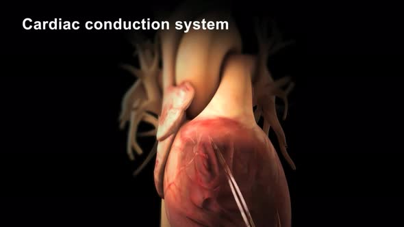 Catheter ablation is the treatment of arrhythmia with radio waves.