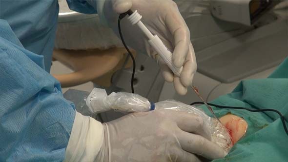 Doctor's Hands And Radiofrequency Ablation