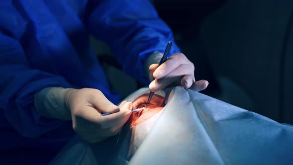 Surgeon performing operation. Surgeon operating eye cataract in hospital surgery