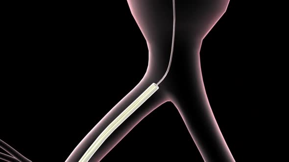 Endovascular Abdominal Aortic Aneurysm Repair