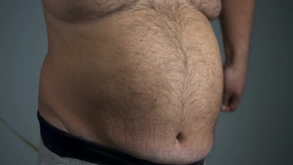 Sad Overweight Man Unable to Measure His Waist, Fat Tummy with Stretch Marks