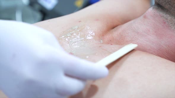 The doctor-cosmetologist in special gloves puts the gel on the patient's body