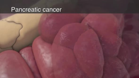 pancreatic cancer  medical animation